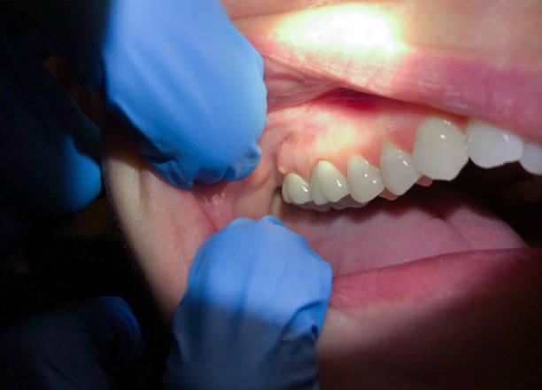 Best Emergency Dental Care for Abscessed Tooth in Wilmington Island, GA
